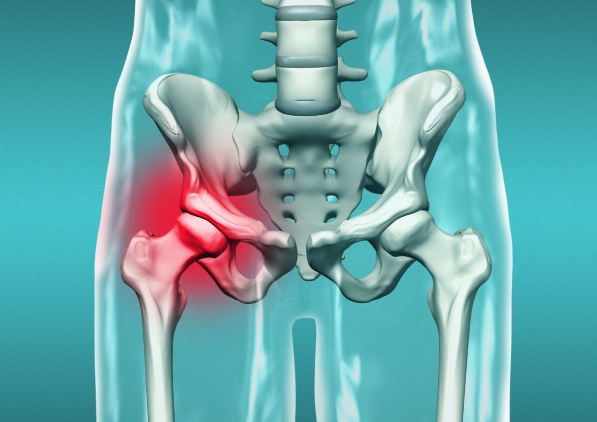 5 Hip Replacement Options in Kolkata: Choosing the Right One