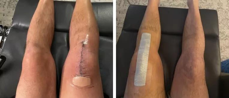 Recovery After Robotic Knee Replacement